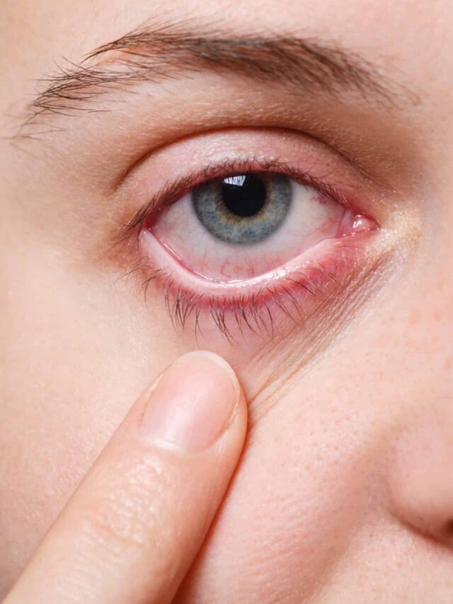Medicine, health care and eyesight concept. Unrecognizable female shows her inflated red eye with blood capillary, has conjuctivitis. Woman with injured eye